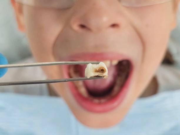Best Emergency Broken Tooth Repair in Strasburg, OH